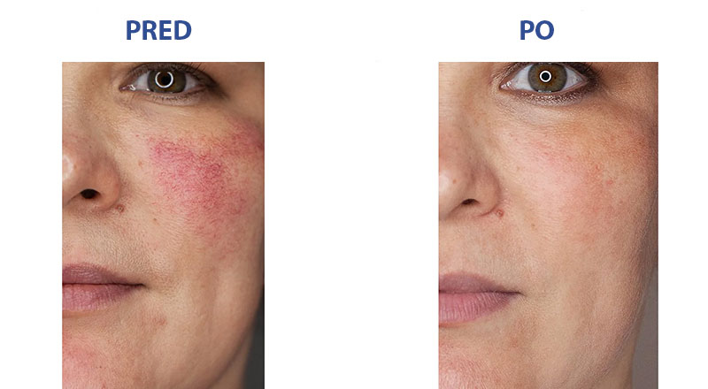 Rosacea-pred-po-svens-island-800x440